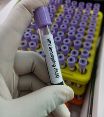 Poster - Blood sample for Human papillomavirus (HPV) genotyping testing in PCR laboratory. hrHPV genotypes test.