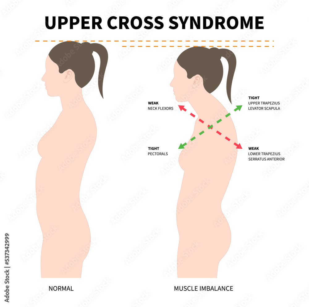 upper cross syndrome with trapezius and dowager’s painful spinal of ...