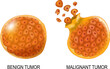 Cancer cells in Benign neoplasm and Malignant tumors.