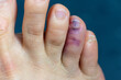 Close-up view of a toe that received a violent blow and turned purple. Purple bruise on a toe wounded after being bashed.