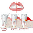periodontitis and gingivitis. Diagram with disease of teeth and gums. Medical poster vector illustration