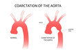 Heart coarctation of the aorta high blood pressure and Turner's disorder