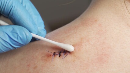 Close-up, a doctor in medical sterile gloves cotton swab treated with antiseptic bleeding wound on the shoulder of a teenage girl