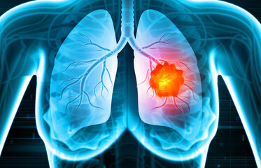 Medical Illustration showing lung cancer or bronchial carcinoma. 3d illustration