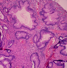 Canvas Print - Gastric polyp biopsy: Adenomatous polyps. Showing gastic mucosa, a polypoid growth of dilated gastric glands and oedematous stroma lined, stomach polyps.