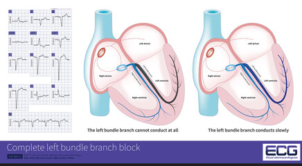 Wall Mural - In complete left bundle branch block, the conduction of the LBB can be completely interrupted or can still be conducted, but it is delayed by at least 45ms than the RBB.