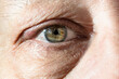 male eye with thickening on eyelid from chalazion closeup
