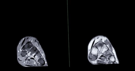 Poster - mri of ankle joint for diagnosis tendon of ankle joint injury from ankle sprain.