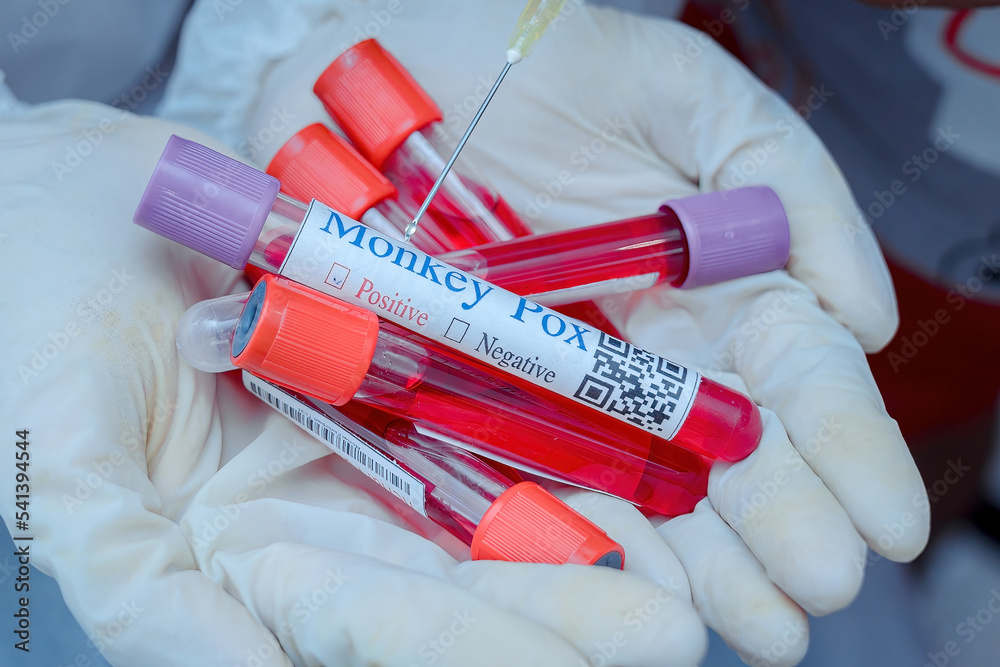 Monkey pox PCR test tube in doctors hand, medical worker in face mask ...