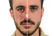 Man face with red skin rosacea before and after couperose treatment
