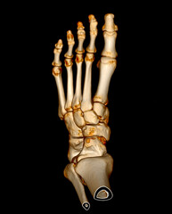 Poster - 3d rendering of the foot bones for diagnosis bone fracture and rheumatoid arthritis.
