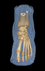 Poster - 3d rendering of the foot bones for diagnosis bone fracture and rheumatoid arthritis.