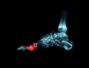 Poster - 3d rendering of the foot bones for diagnosis bone fracture and rheumatoid arthritis.