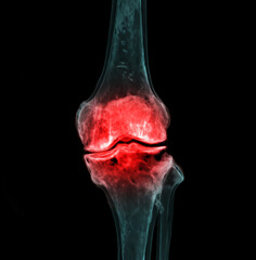 Poster - 3d renderering of the knee joint  isolated on black background Showing pain area.