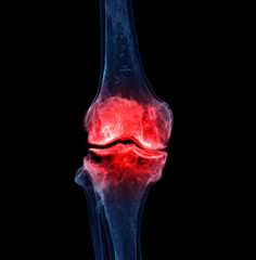 Poster - 3d renderering of the knee joint isolated on black background showing pain area.