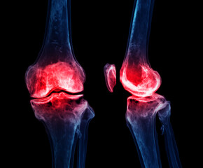 Poster - 3d renderering of the knee joint  isolated on black background Showing pain area.