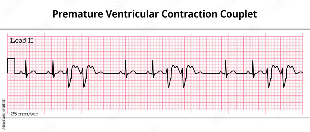 Vector de Stock ECG Premature Ventricular Contraction Couplet - 8 ...