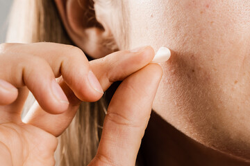 woman using acne patches for treatment of pimple and rosacea close-up. facial rejuvenation cleansing