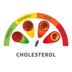 Different stages of cholesterol plaque buildup in artery. Low to high fat count in blood vessel medical diagram. Meter gauge of ldl and hdl lipoprotein. Atherosclerosis risk indicator illustration.