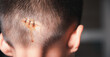 © sorapop - The lacerated sutured wound of kid back head which suture by nylon suture about 3 stitches at the emergency room of the hospital, Medical care of the surgery lesion on the head, children of Accident
