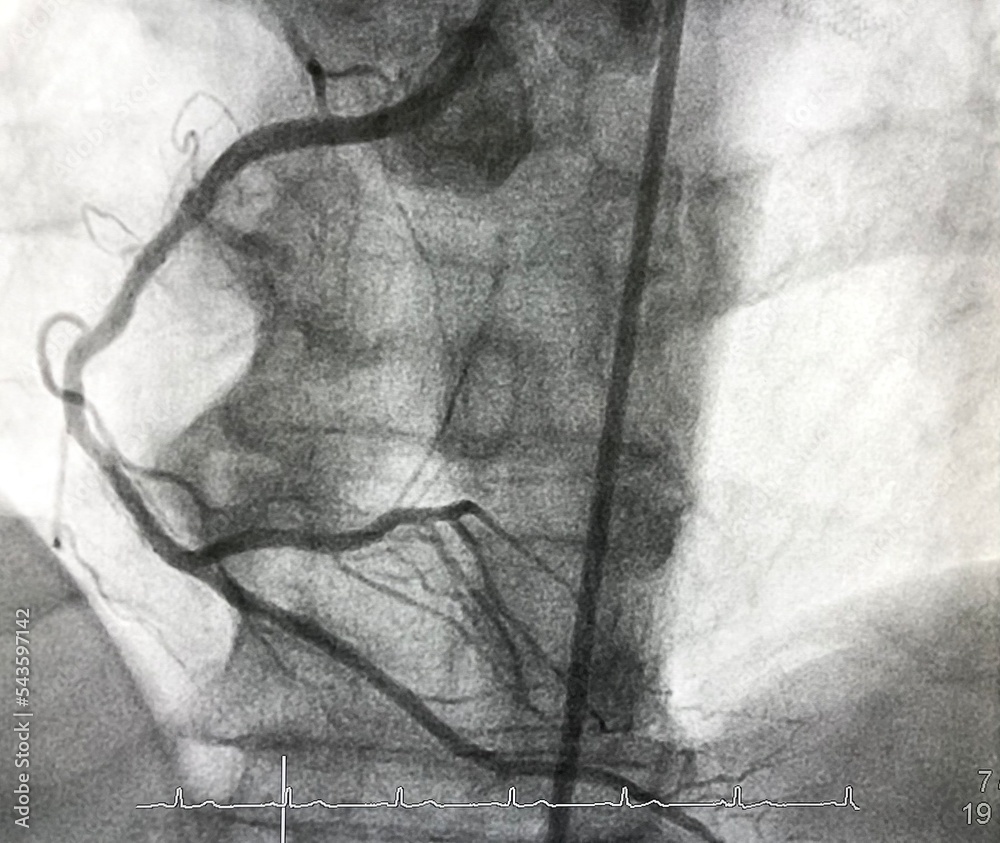Coronary angiogram (CAG) of right coronary artery (RCA).