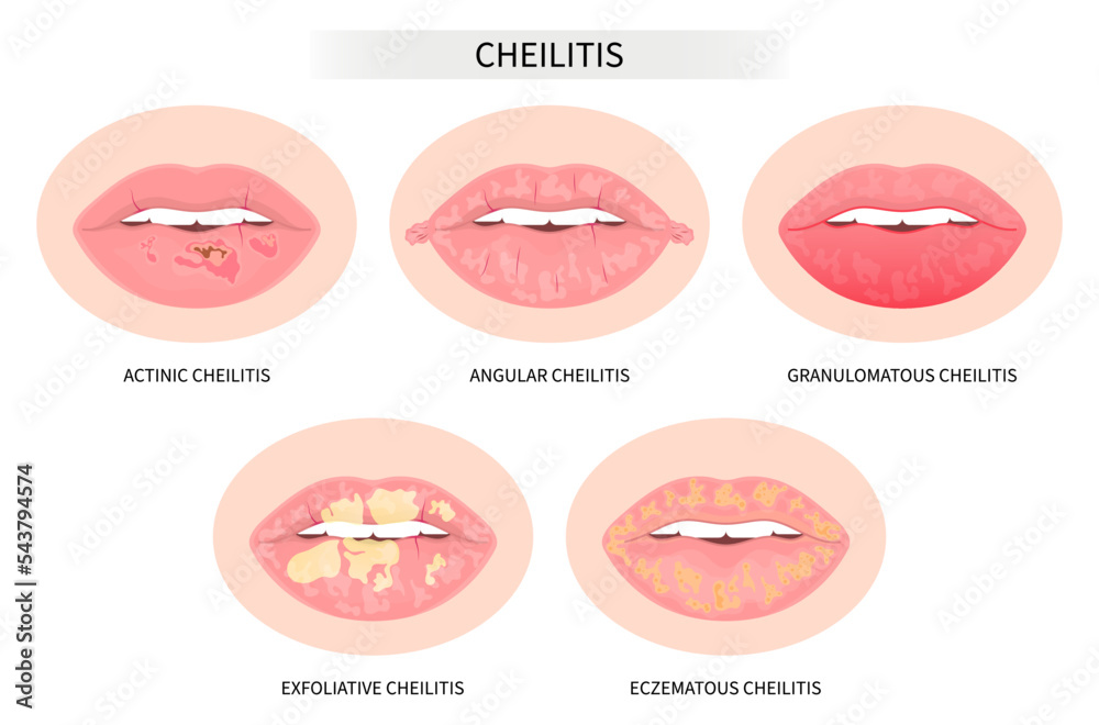 Types of dry lip fungal oral cold sore skin pain tongue Licker's ...