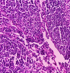 Canvas Print - Caecum lymph node biopsy: Chronic nonspecific lymphadenitis. Photomicrograph show lymph node, features of reactive change.