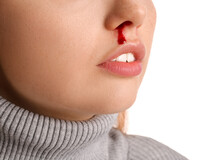 Young Woman With Nosebleed On White Background, Closeup