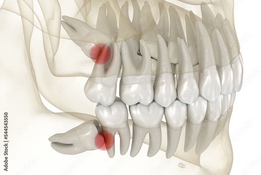 Mesial impaction of Wisdom teeth. Medically accurate tooth 3D ...