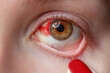 Close up of sick eye with red bloodshot veins. Selective focus