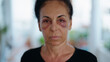 Middle age hispanic woman suffering for domestic violence with bruise on eyes at home terrace