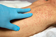Exacerbation of atopic dermatitis in a child on the body is examined by a dermatologist. Skin rashes on the body of a sick child with large red spots