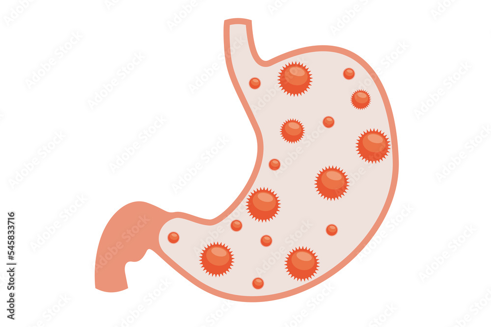 Stomach ache vector. Diseases of the human stomach. Human stomach ...