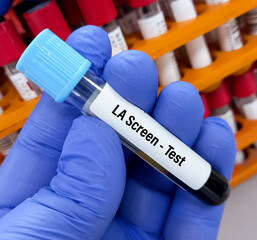 Lab Technologist hold blood sample for LA(Lupus Anticoagulant) Screen test. Laboratory medical testing concept.