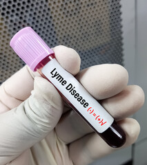 Poster - Blood sample for Lyme disease testing. Borrelia burgdorferi.