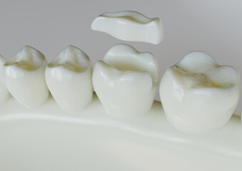 Wall Mural - Ceramic Inlay crown over a tooth- 3D Rendering