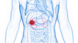 3D rendered Medical Illustration of Male Anatomy - Kidney Cancer.