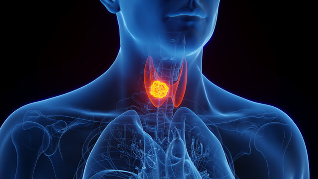 3D Rendered Medical Illustration of Male Anatomy - Thyroid Cancer.