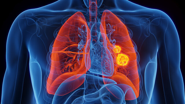 3D Rendered Medical Illustration of Male Anatomy - Lung Cancer.