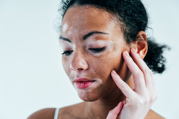 Beautiful woman with vitiligo skin posing in studio. Concept about body positivity and self acceptance