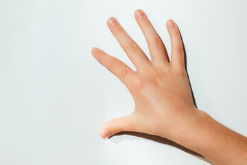 Children's hand with a wart on a white background. Papilomavirus. View from above