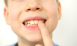 close-up hand of child, boy of 9 years old points new tooth fang in mouth with finger, concept of children's health, pediatric dentistry, dental correction of occlusion, treatment of crooked teeth
