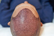 Detail of scalp of male lying down after hair transplant surgery 