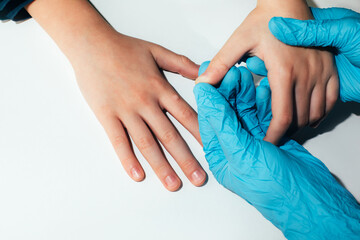 Children's hand with a wart on a white background. Papilomavirus. Top view