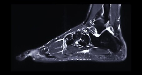 Poster - MRI foot scan for a diagnostic of the foot and ankle following symptoms: pain  both feet, swelling, redness or warmth, numbness or tingling and stiffness.