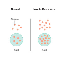 Wall Mural - Insulin Resistance Concept Design. Vector Illustration.