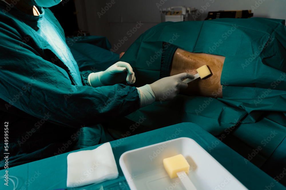 Doctor or surgeon apply betadine to the patient for anesthesia ...