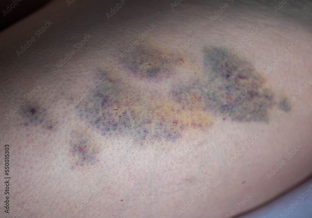 photo-stock-bruises-on-the-skin-of-the-patient-s-leg-after