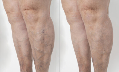 detail of one with smooth and beautiful legs of an elderly person, with varicose veins. Before and after concept. background, white background The concept of varicose disease.