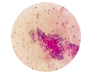 Sticker - Microscopic view of Trichomonas vaginalis in pap smear with few acute inflammatory cells. Cytology and pathology laboratory department. Sexually transmitted disease. Trichomoniasis